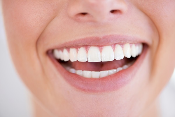 Take Home Trays From Your Dentist Are A Teeth Whitening Option